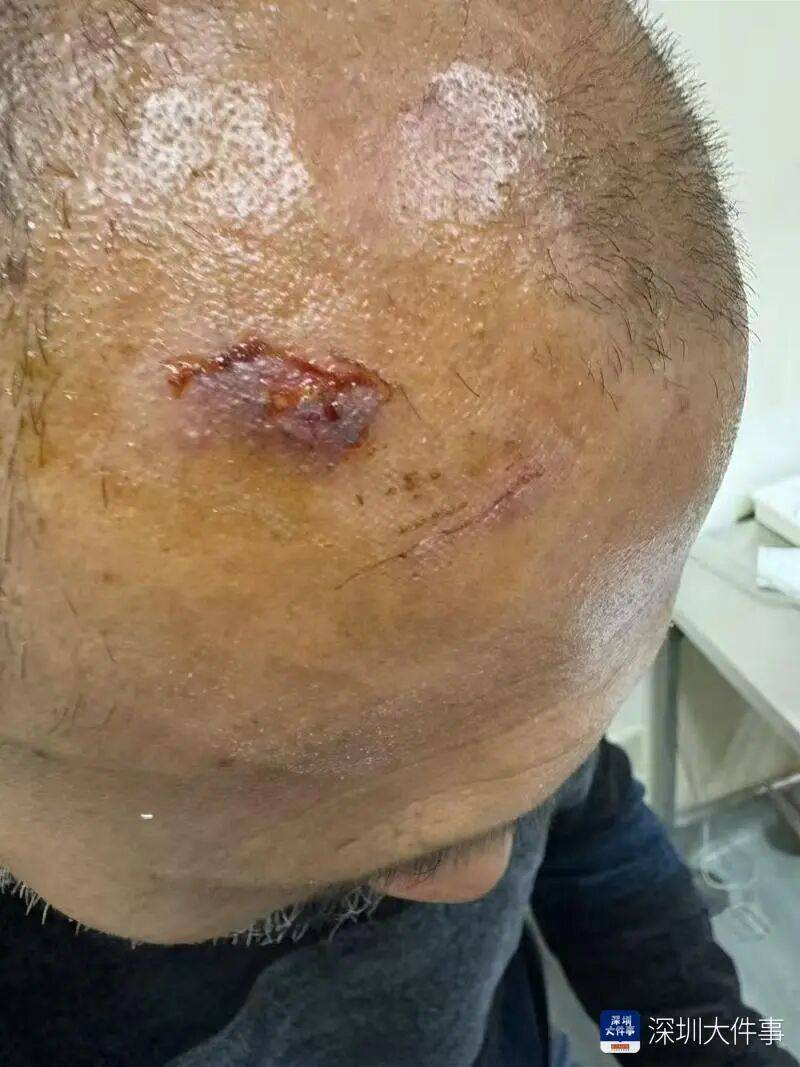 世界杯皇冠信用网开户_“影响我的形象”！一男子在深圳湾遭遇意外世界杯皇冠信用网开户，头皮被戳破！部门回应